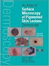 An Atlas of Surface Microscopy of Pigmented Skin Lesions: Dermoscopy, Second Edition
