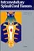Intramedullary Spinal Cord Tumors by Gerhard Fischer