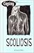 Coping With Scoliosis