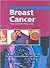 Breast Cancer (Perspectives on Disease and Illness)