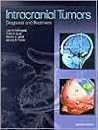 Intracranial Tumors: Diagnosis and Treatment Intracranial Tumors: Diagnosis and Treatment