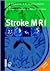 Stroke MRI