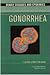 Gonorrhea