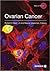 Ovarian Cancer