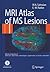 MRI Atlas of MS Lesions