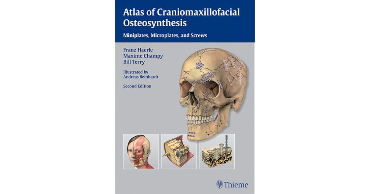Plate osteosynthesis image