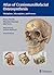 Atlas of Craniomaxillofacial Osteosynthesis: Microplates, Miniplates,and Screws