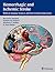 Hemorrhagic and Ischemic St...