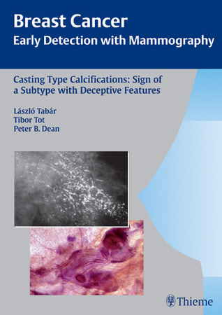 Casting Type Calcifications: Sign of a Subtype With Deceptive Features (Breast Cancer: Early Detection With Mammography)