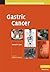 Gastric Cancer