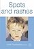 Spots and Rashes