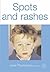 Spots and Rashes by June Thompson