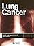 Lung Cancer by Jack A. Roth