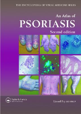 An Atlas of Psoriasis (Hardcover)