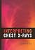 Interpreting Chest X-Rays