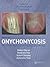 Onychomycosis: The Current ...
