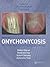 Onychomycosis by Robert Baran