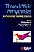 Thoracic Vein Arrhythmias: Mechanisms and Treatment