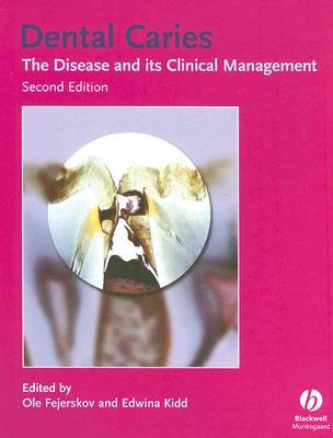 Dental Caries: The Disease and Its Clinical Management (Hardcover)