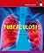Tuberculosis (Health Alert)