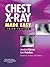 Chest X-Ray Made Easy E-Book