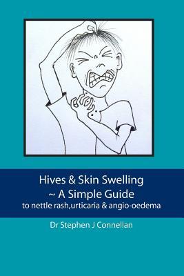 Hives & Skin Swelling ~ A Simple Guide: to nettle rash,urticaria & angio-oedema