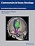 Controversies in Neuro-Oncology: Best Evidence Medicine for Brain Tumor Surgery