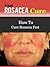 Fast Rosacea Cure - How To ...