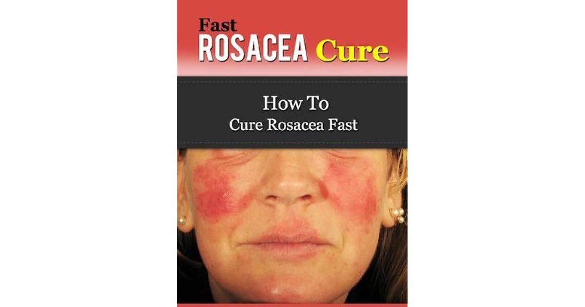 Fast Rosacea Cure How To Cure Rosacea Fast by Ben Taylor