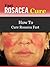 Fast Rosacea Cure - How To Cure Rosacea Fast by Ben Taylor
