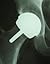 Hip Replacement Using The B...