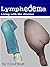 Lymphedema - Living with the disease