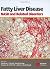 Fatty Liver Disease: NASH a...