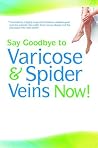 Say Goodbye to Varicose & Spider Veins Now!
