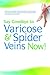Say Goodbye to Varicose & Spider Veins Now!