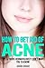How To Get Rid Of Acne: Tips & Tricks Dermatologists DON'T Want You To Know...