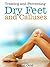 Treating And Preventing Dry Feet and Calluses How To Remove C... by David Gold