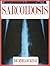 Sarcoidosis (Medicine Book 9)