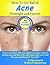 How To Get Rid of Acne Overnight and Forever 