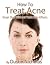 How To Treat Acne - Great S...