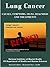 LUNG CANCER: Causes, Symptoms, Signs, Diagnosis, Treatments, Stages Of Lung Cancer - Revised Edition - Illustrated by S. Smith