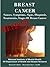 BREAST CANCER Causes, Sympt...