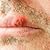 The Ultimate Guide Of Herpes Removal That Will Teach You Everything About Removing Herpes Naturally That You Need To Know ASAP. It Will Tell You About ... No Matter How Tough Your Case Might Be!