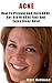 ACNE: How To Prevent And Cure ACNE, Get Rid Of ACNE Fast And Enjoy Clear Skin! (acne cure, acne medicine, acne prevention, acne remedies)