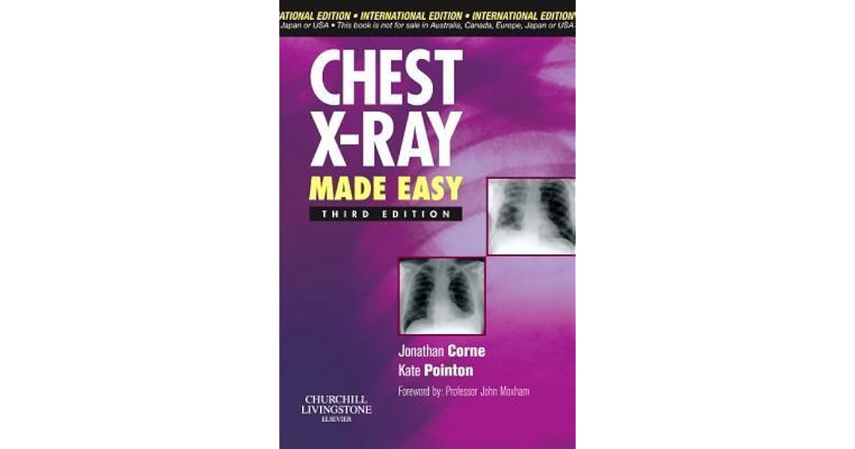 Chest XRay Made Easy by Jonathan Corne