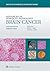 Advances in Surgical Pathology: Brain Cancer