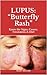LUPUS: “Butterfly Rash”: Kn...
