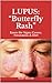 LUPUS: “Butterfly Rash”: Know the Signs, Causes, Treatment, & Diet