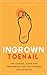 Ingrown Toenail: The Causes, Signs and Treatments for this painful nail disease: Nails, Toe Nails, Ingrown, Pain, Healing, Treatment, Signs, Natural Remedies, Trimming, Skin Care, Foot Care,