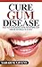 Gum Disease Cure (Gum Disease Cure, Periodontal Disease, Gum Disease, Gum Infection, Gingivitis treatment, Tooth Decay)